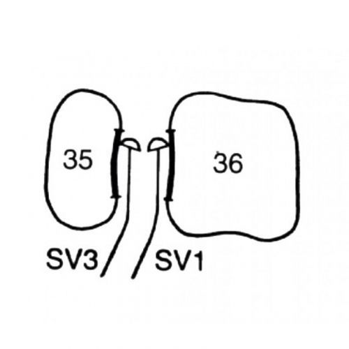 Кюрета пародонтологическая для квадрантов 1 и 3 Interproximal Curette SV 1-3 LM 251-253 — дополнительное фото
