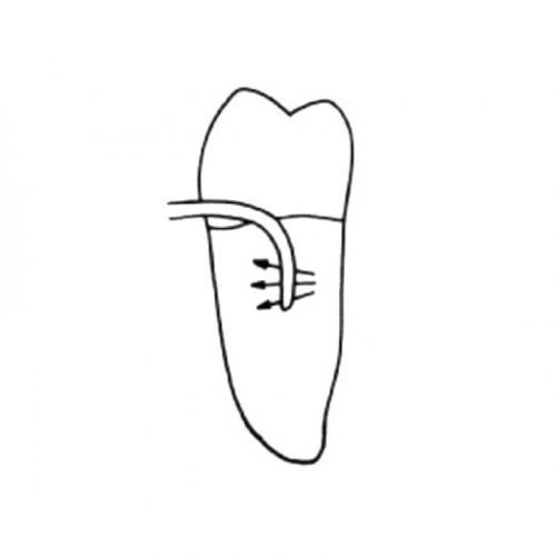 Кюрета пародонтологическая для квадрантов 2 и 4 Interproximal Curette SV 2-4 LM 252-254 — дополнительное фото