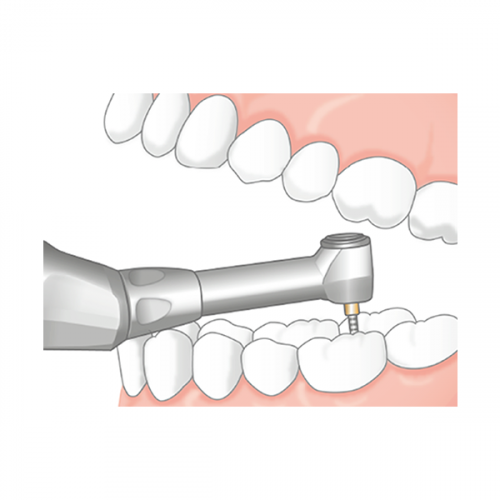 Endo-Mate TC2 MPA - беспроводной эндодонтический микромотор с возможностью быстрого подключения апекслокатора — дополнительное фото